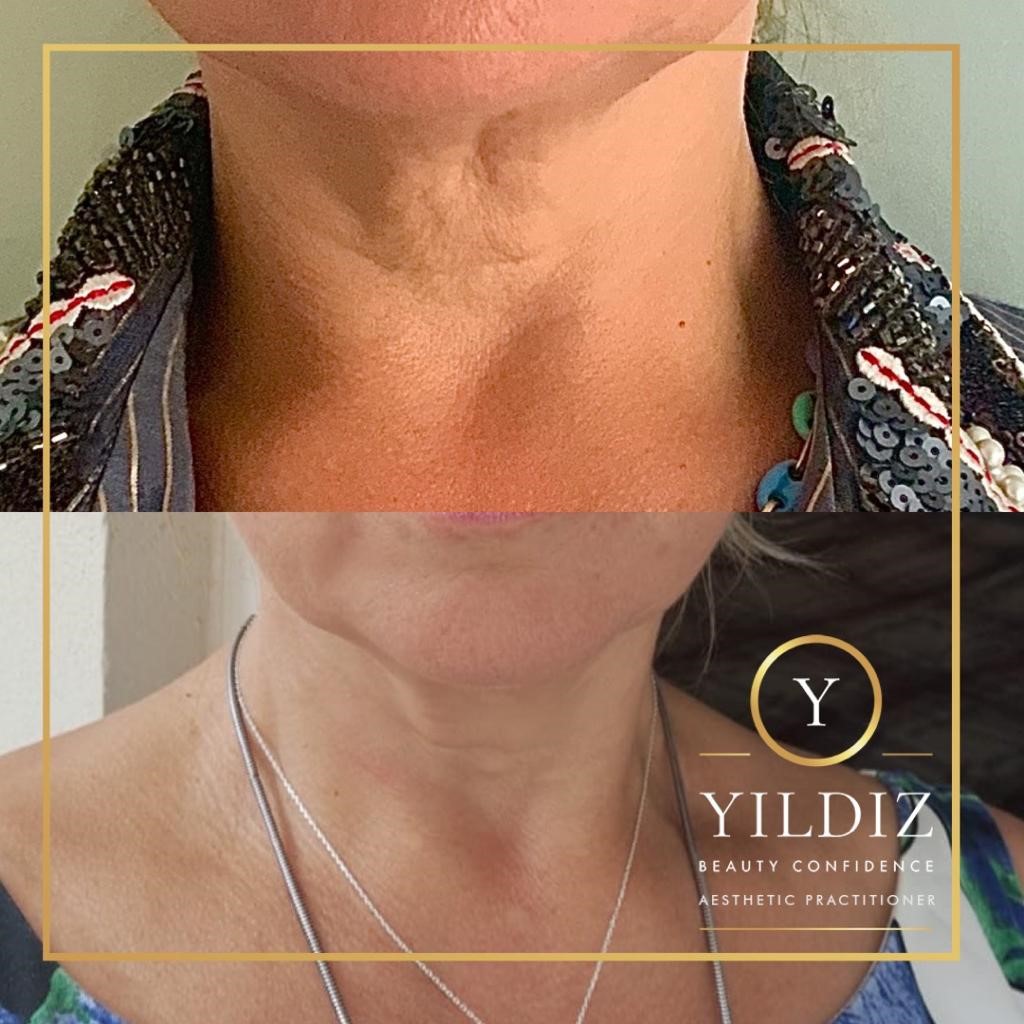 Side by side iLLUMA product results on neck