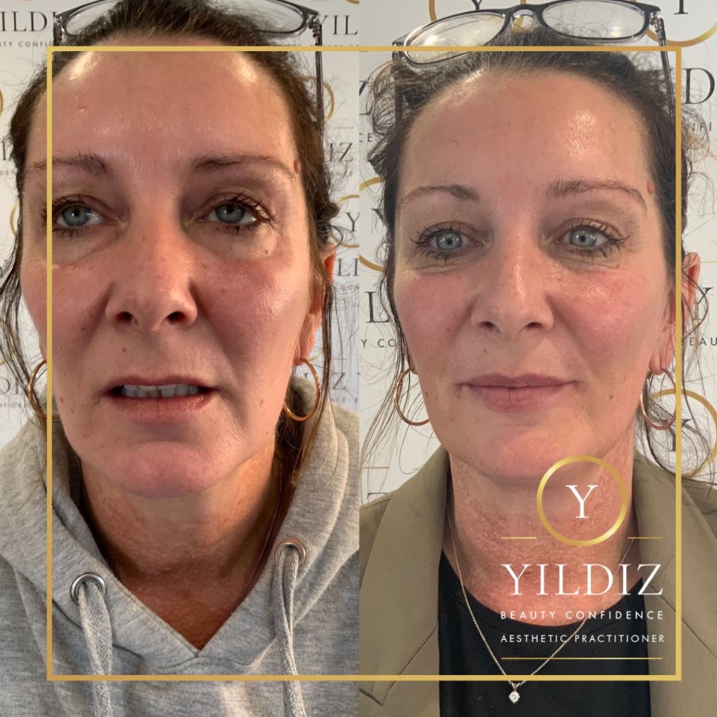 Side by side iLLUMA product results